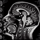 МРТ скронево-нижньощелепного суглоба